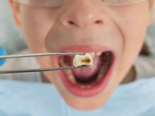 Best Emergency Gum Treatment in Mcgraw, NY