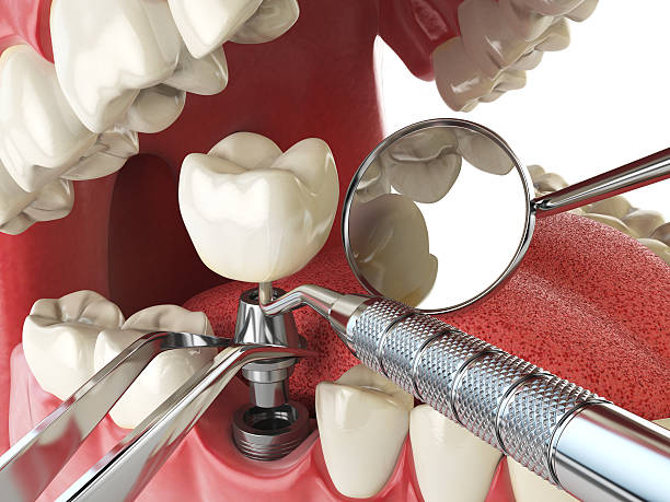 Best Emergency Dental Care for Broken or Chipped Teeth in Mcgraw, NY